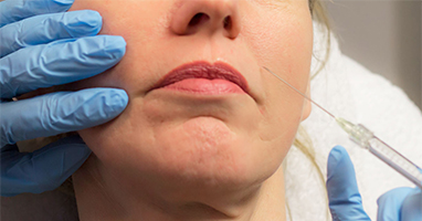 Ooglidcorrectie bovenste oogleden