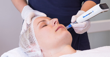microneedling
