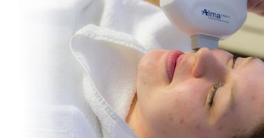 LASERBEHANDELING VOOR ACNE(LITTEKENS)
