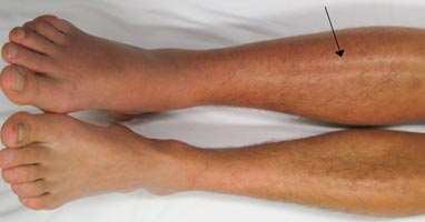 ONTSIERENDE BEENVAATJES