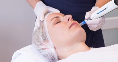 MICRONEEDLING